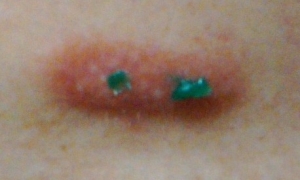 患部の面積が広いので2か所に塗ってみた